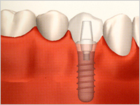 新しく作成した歯をインプラントに固定